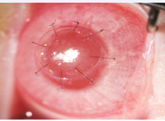 高透光人工角膜（E-Col）